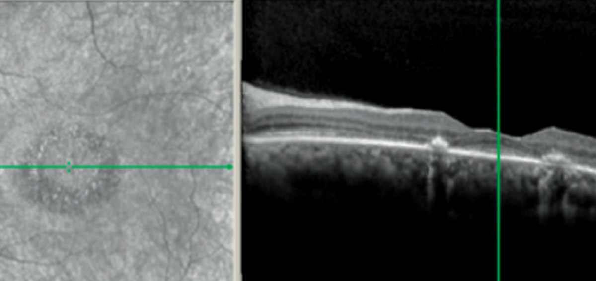 retinopatia da idrossiclorochina fondo oculare oct