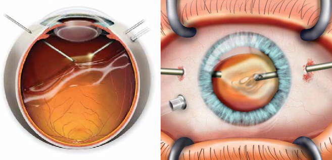 intervento chirurgico della vitrectomia il trattamento della patologia maculare trazionale, ovvero delle membrane epiretiniche, dei fori maculari e delle trazioni vitreoretiniche