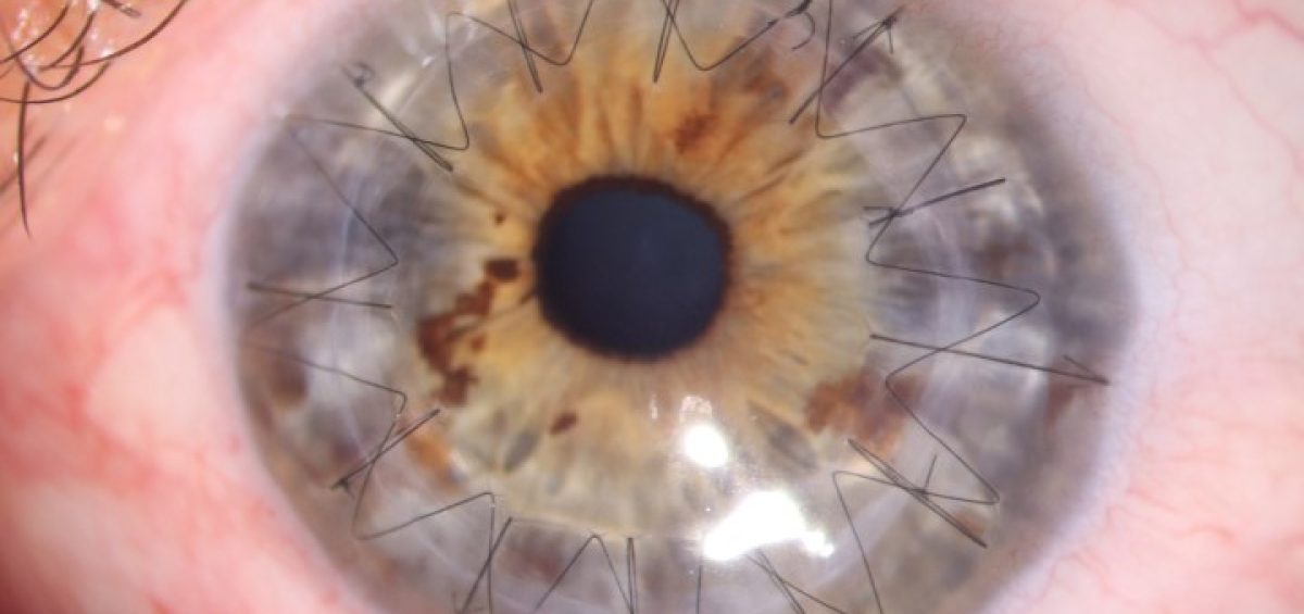 tipi di trapianto di cornea