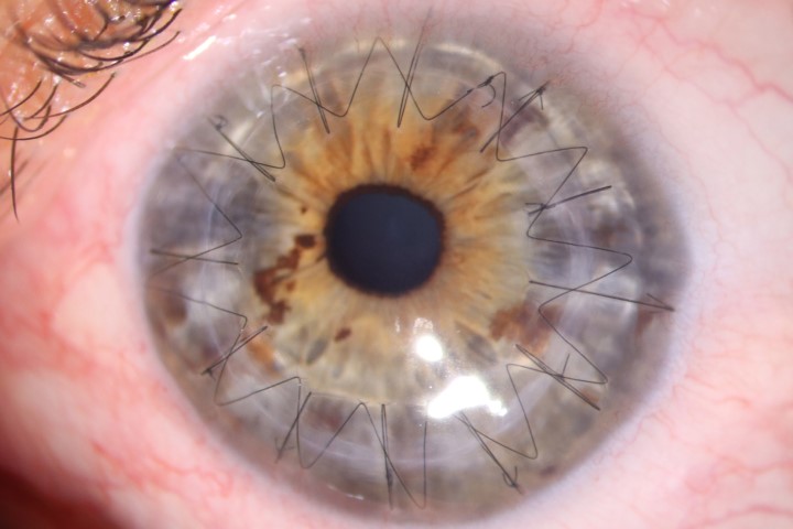 tipi di trapianto di cornea